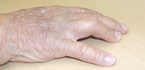 第4 指のPIP関節の屈曲