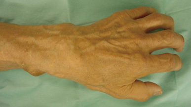 手背の腫瘤形成と手指の伸展障害